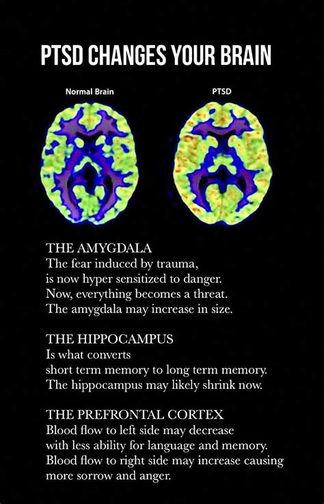 Limbic Retraining Strategies To Improve Limbic System Function Artofit