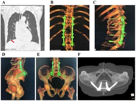 Sacral And Thoracic Chordoma With Pulmonary Metastases A Case Report