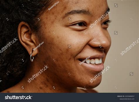 14384 Acne Scars On Face Images Stock Photos And Vectors Shutterstock