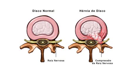 Descompress O Endosc Pica Da Coluna Tudo O Que Voc Precisa Saber
