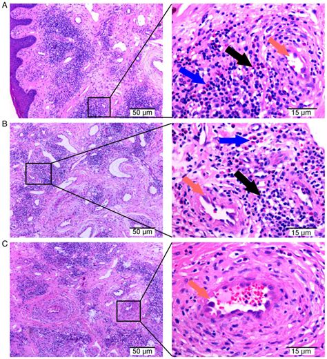 Rare Angiolymphoid Hyperplasia With Eosinophilia Examined Through Fine