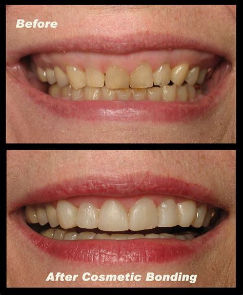 Black Stains On Teeth Near Gums Teethwalls 9DA