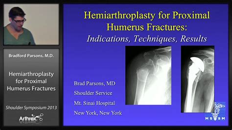 Arthrex Proximal Humeral Fractures Hemiarthroplasty Presentation 4