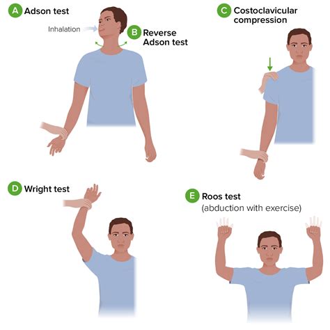 Thoracic Outlet Syndrome Concise Medical Knowledge