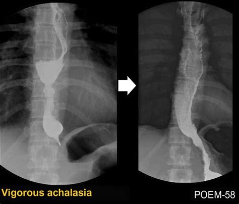 Barium Esophagogram Before Left And After Right Peroral Endoscopic