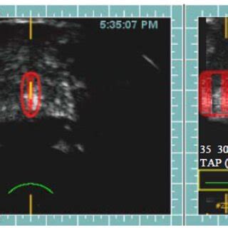 The Sonablate Probe Tip With A Confocal Imaging And HIFU Transducer