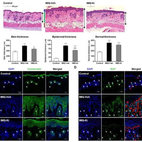 Ki16425 Decreases Epidermal Thickening And Keratinocyte Proliferation