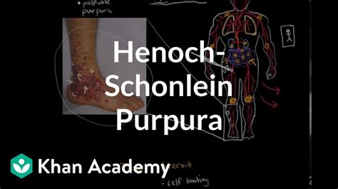 How Common Is Hsp In Adults The 10 Correct Answer