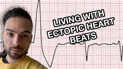 5 Tips For Living With Anxiety And Ectopic Heart Beats Youtube