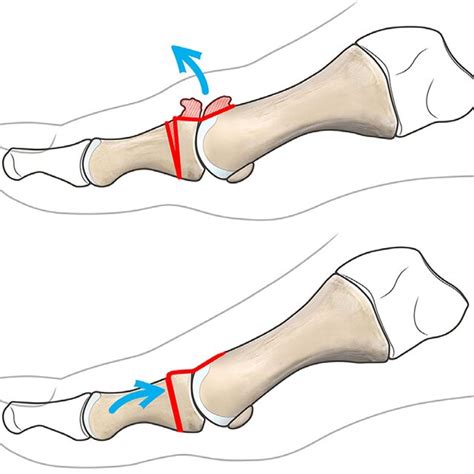 Cheilectomy Involves The Resection Of 25 30 Of The Dorsal Metatarsal