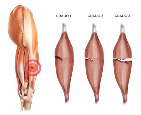 C Mo Tratar Un Desgarro Muscular Desde La Fisioterapia