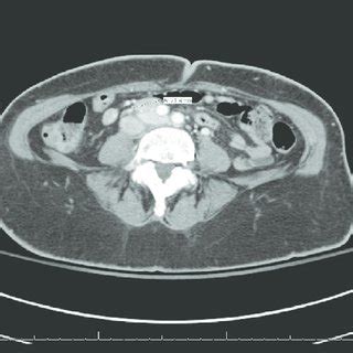 Computed Tomography Scan Of Abdomen Showing Retroperitoneal