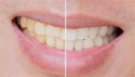 How To Remove Stains Between Teeth A Comprehensive Guide Top Globe News