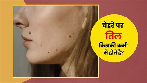 चेहरे पर तिल किसकी कमी से होते हैं डॉक्टर से जानें कारण Which