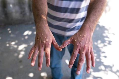 Variole du singe Un cluster en train de se développer dans un camping