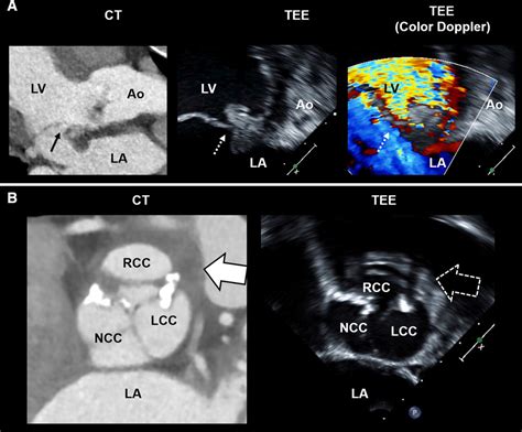 Comparison Of Cardiac Computed Tomography With Transesophageal