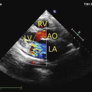 Preoperative Transthoracic Echocardiography Parasternal Long Axis