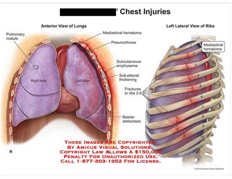 Amicus Illustration Of Amicus Injury Lung Pulomary Nodule Mediastinal