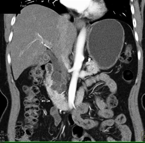 Serous Cystadenoma Head Of Pancreas With Dilated Common Bile Duct