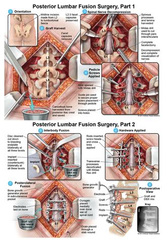 Posterior Lumbar Fusion Surgery By Sarah Faris Spinal Fusion Surgery