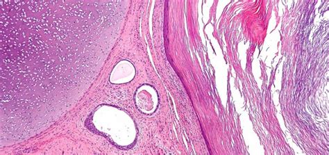 Teratomas The Tumors With Teeth