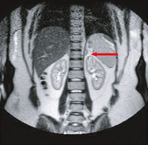 Mri Abdomen In The Axial View Showing A Normal Left Adrenal Gland Download Scientific Diagram