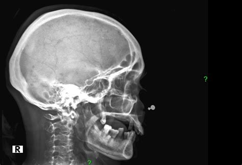 Multiple Myeloma Image