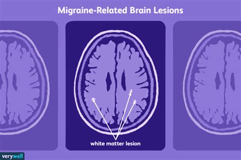 Understanding Migraine Related Brain Lesions On Your Mri