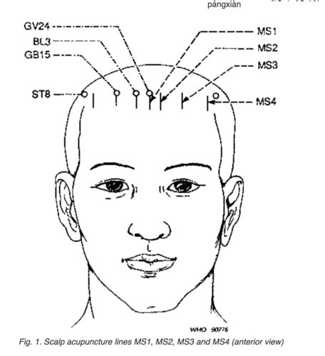 Scalp Acupuncture Flashcards Quizlet