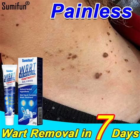 Sumifun Original Warts Remover Ointment G Effectively Remove Common