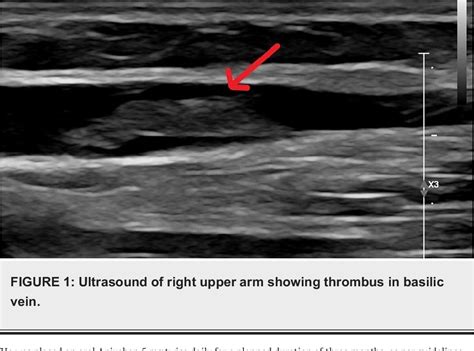 Figure 1 from Isolated Basilic Vein Thrombosis as a Rare Presentation of COVID-19 in a Young ...