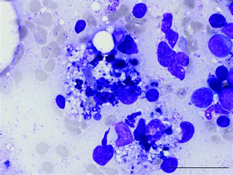 Hemophagocytosis In Bone Marrow Aspiration Smear Wright Giemsa Stain