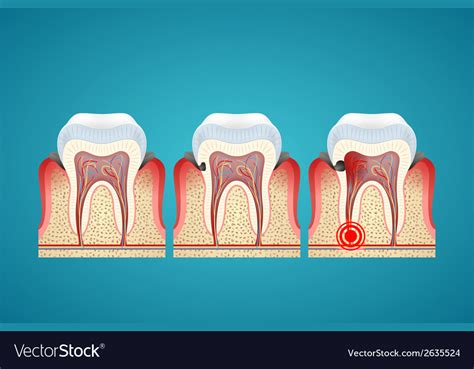 Dental Caries Progression