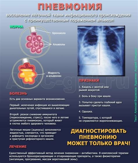 Пневмония на рентгене: как выглядит воспаление легких на рентгеновском ...