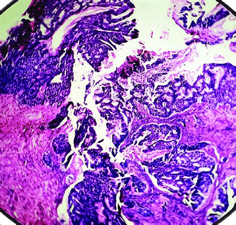 Scanner View Showing Islands Of Basaloid Cells Download Scientific