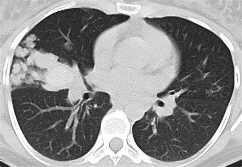 Congenital Pulmonary Airway Malformation A Rare Diagnosis In Adulthood