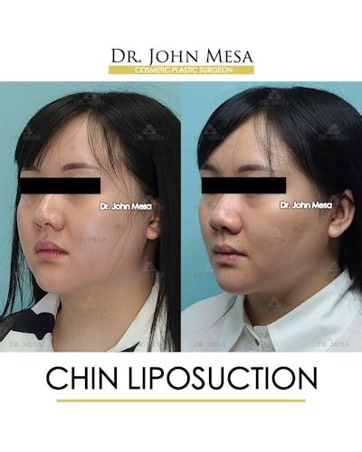 Patient Maicbn68s Mf6axlrnhz2q Chin Liposuction Before And After Photos