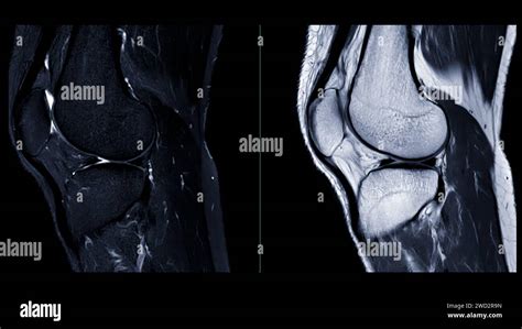 Magnetic Resonance Imaging Or MRI Of Knee Joint This Diagnostic