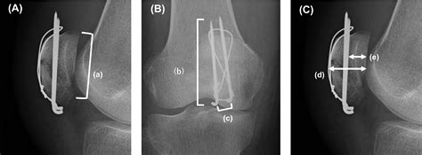 Predictors Of Postoperative Complications Of Tension Band Wiring