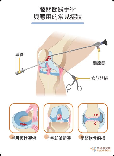 傷口小、術後恢復快 微創關節鏡手術正夯