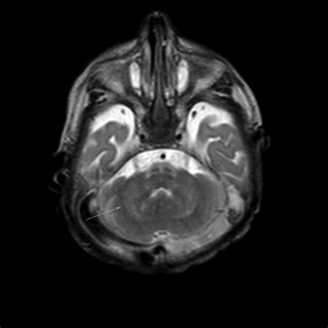 T2 Weighted Mri Image Showing Bilateral Dentate Nucleus Hyperintensity Download Scientific Diagram