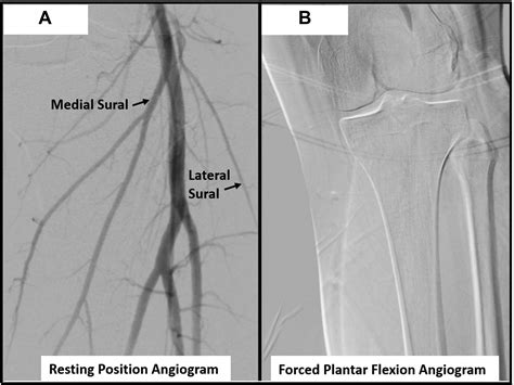 Dynamic Imaging Is The Ideal Modality For The Diagnosis Of Popliteal Artery Entrapment Syndrome