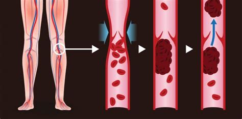 Deep vein thrombosis | New Life Ticket