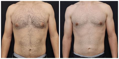 Severe Gynecomastia Before And After