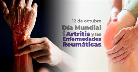 Día Mundial de la Artritis y las Enfermedades Reumáticas 12 de