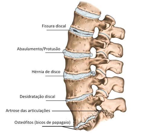 Total Imagem Quais Os Sintomas De Bico De Papagaio Na Cervical Br