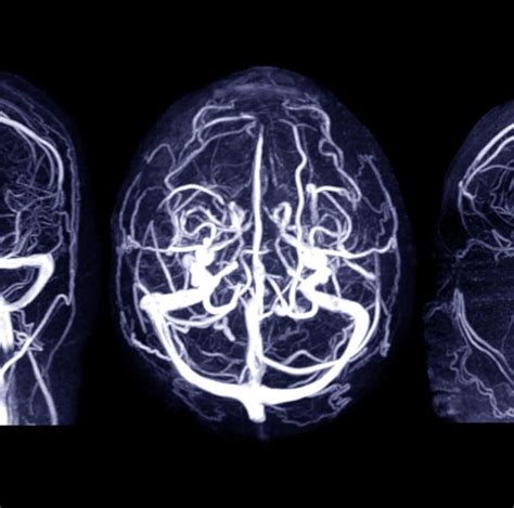 Aneurisma Cerebral O Que Causas Sintomas E Tratamento Minha Vida