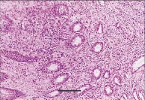 Photomicrograph Of The Colonic Biopsy Obtained From A 1 Year Old Download Scientific Diagram