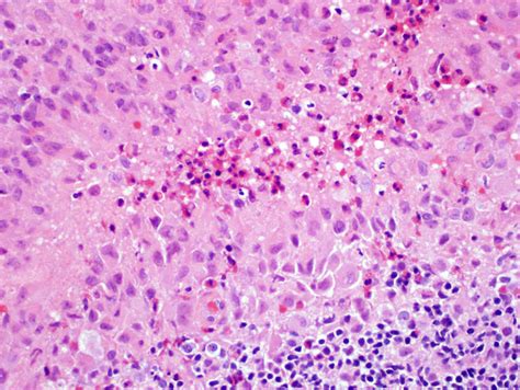 Pathology Outlines Langerhans Cell Histiocytic Neoplasms