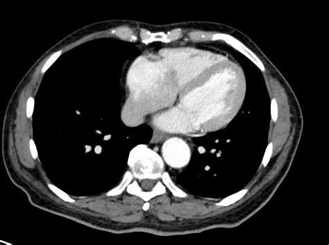 Ventricular Septum | Heart